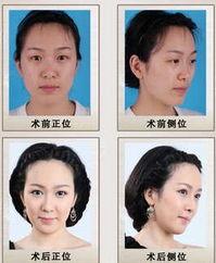 整容下巴照片,揭秘整容下巴的神奇蜕变